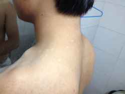 白癜风症状