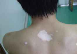 白癜风症状
