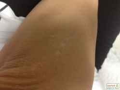白癜风症状